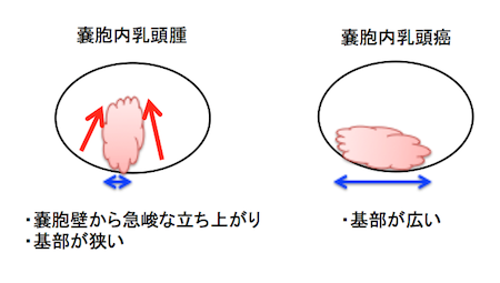 乳管内乳頭腫 の画像診断(intraductal papilloma:IDP)